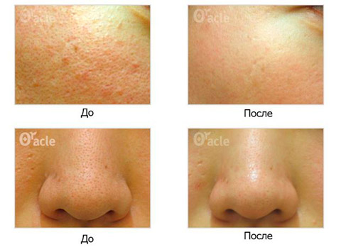 Spot Cleaner вакуумный очиститель пор лица